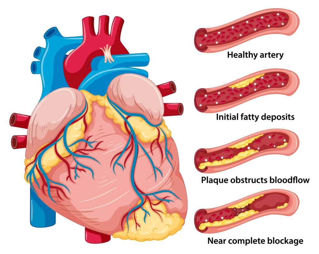 LM Stenting in Bhopal | Dr. Chandra Kumar Singh, Best cardiologist in Bhopal | Dr. Chandra Kumar Singh, Best cardiologist in Bhopal, Dr. Chandra Kumar Singh Best Cardiologist in Bhopal, Heart Specialist in Bhopal, Cardiologist in Bhopal, Heart Doctor in Bhopal, Advanced Cardiac Care in Bhopal, Heart Clinic in Bhopal, Cardiac Consultation in Bhopal