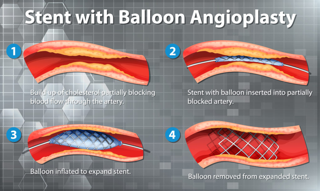 Thrombotic Lesion Angioplasty Bhopal Dr. Chandra Kumar Singh, Best cardiologist in Bhopal | Dr. Chandra Kumar Singh, Best cardiologist in Bhopal, Dr. Chandra Kumar Singh Best Cardiologist in Bhopal, Heart Specialist in Bhopal, Cardiologist in Bhopal, Heart Doctor in Bhopal, Advanced Cardiac Care in Bhopal, Heart Clinic in Bhopal, Cardiac Consultation in Bhopal