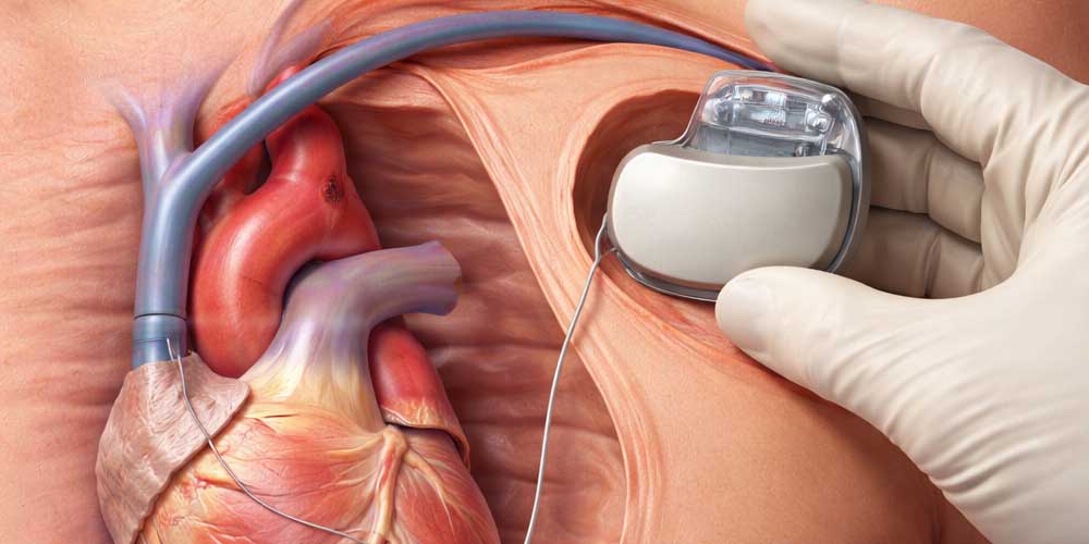 Permanent Pacemaker in Bhopal | Dr. Chandra Kumar Singh, Best cardiologist in Bhopal | Dr. Chandra Kumar Singh, Best cardiologist in Bhopal, Dr. Chandra Kumar Singh Best Cardiologist in Bhopal, Heart Specialist in Bhopal, Cardiologist in Bhopal, Heart Doctor in Bhopal, Advanced Cardiac Care in Bhopal, Heart Clinic in Bhopal, Cardiac Consultation in Bhopal